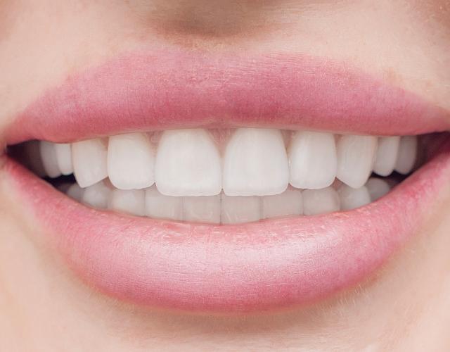 Красивая улыбка после установки имплантов