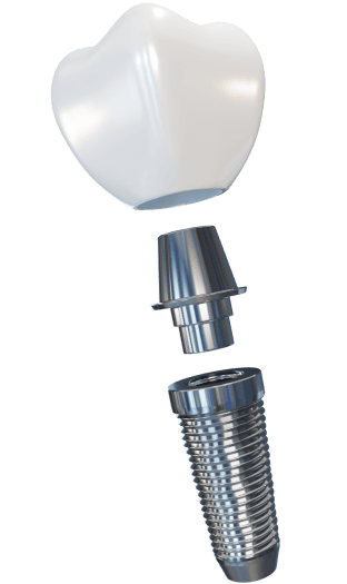 Зубной имплант